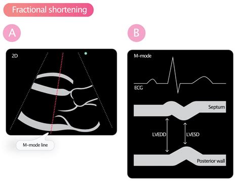 fractional shortening meaning.